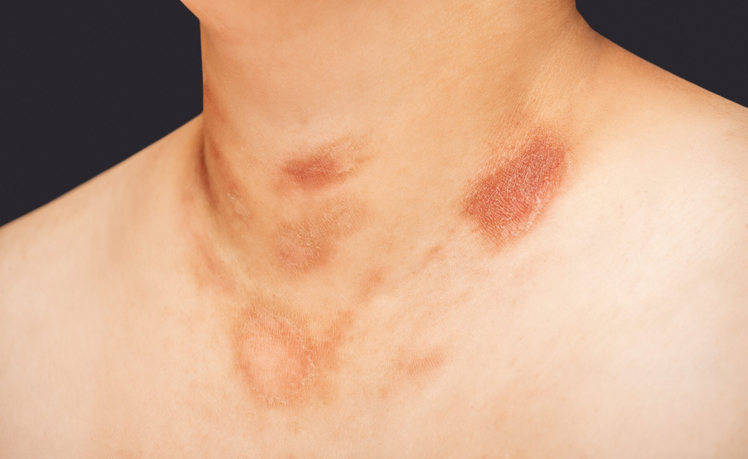 Wat is Pityriasis rosea